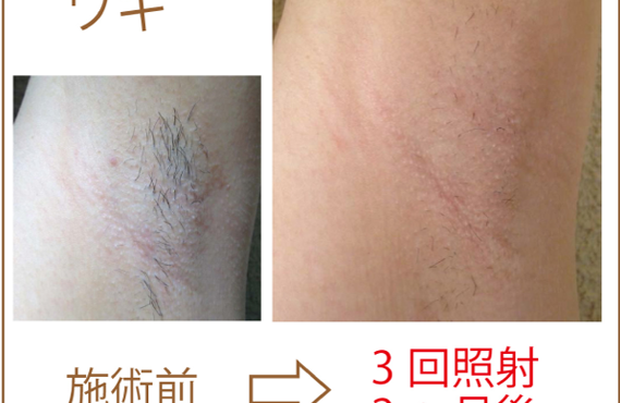 初めての方でも安心脱毛|毛が濃い|ムダ毛が気になる|剛毛で恥ずかしい|女性専門プライベート脱毛サロン