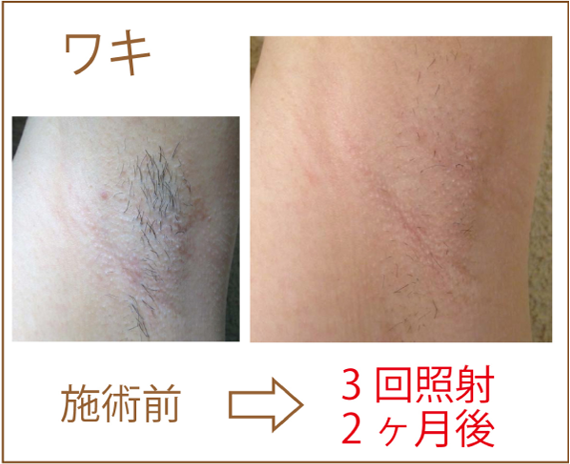 ワキ脱毛
