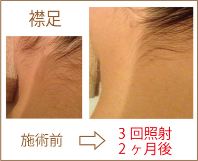 襟足脱毛ビフォーアフター