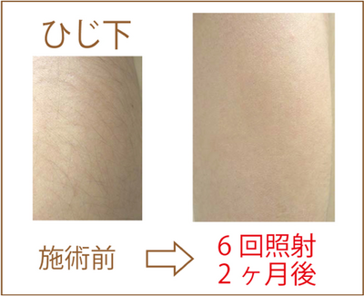 ひじ下脱毛ビフォーアフター
