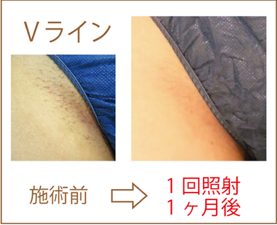Vライン脱毛ビフォーアフター